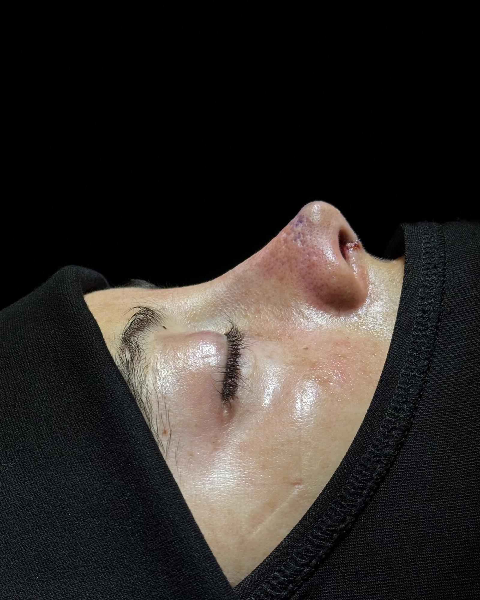 Después de cirugía nasal - Caso 02